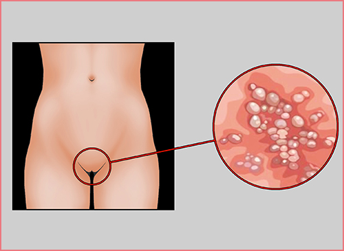 Genital Herpes (Genital Uçuk) Tedavisi