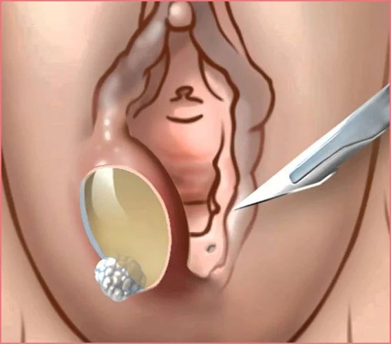 BARTHOLİN KİSTİ VE BARTHOLİN APSESİ