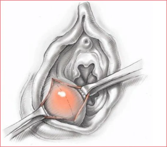 BARTHOLİN KİSTİNİN TEDAVİSİ