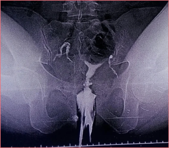 Ağrısız Rahim Filmi (HSG)