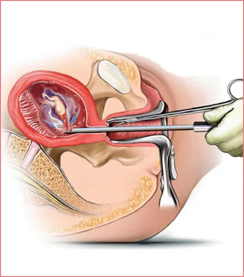 Vajina neden genişler?