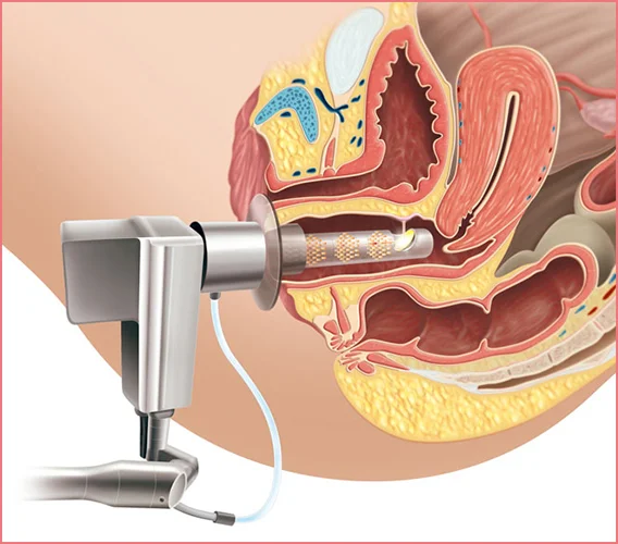 Vajina daraltma ameliyatı ağrılı mıdır